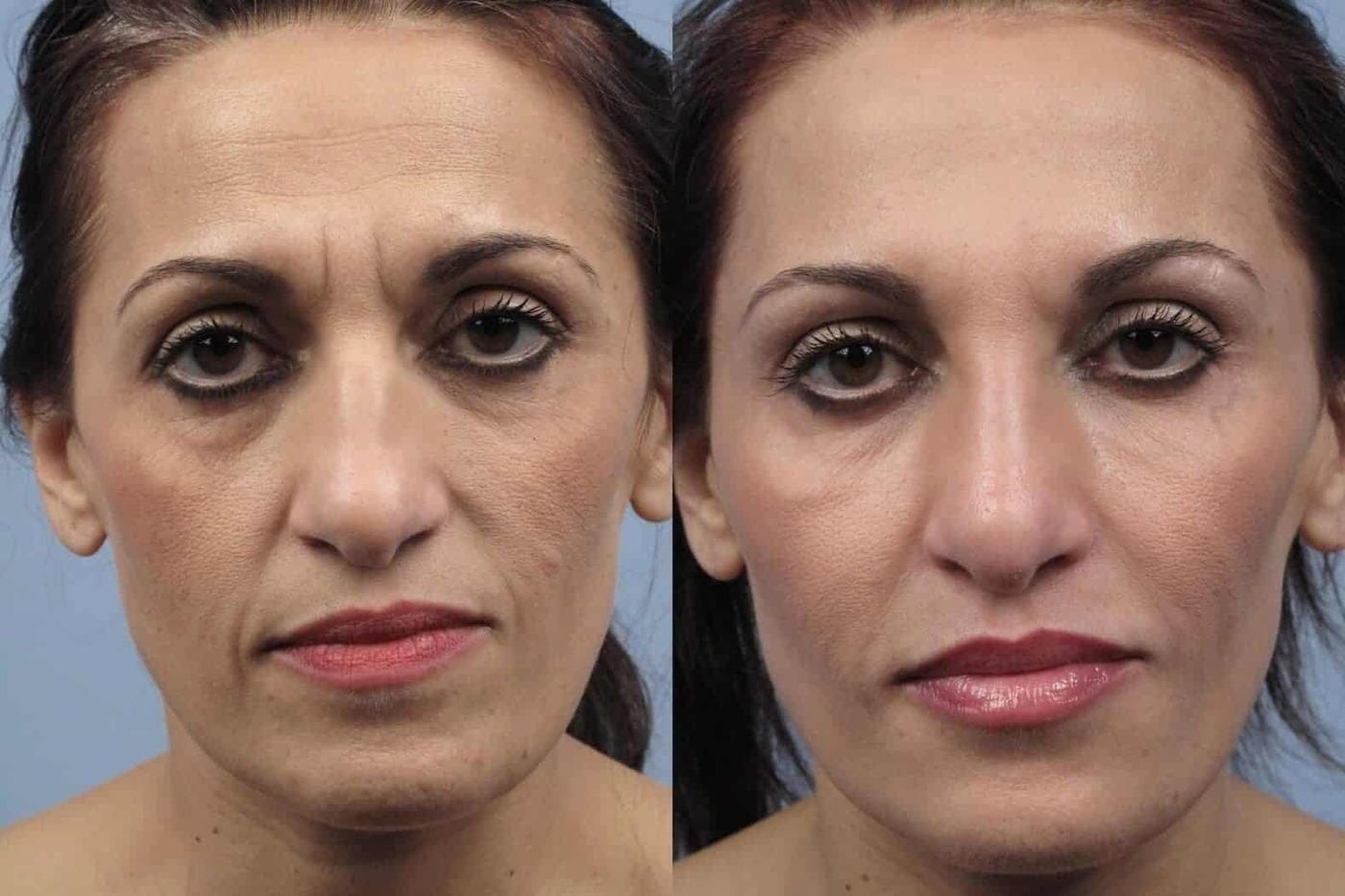 Fractional Laser