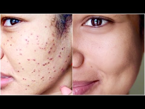 Warts Treatment